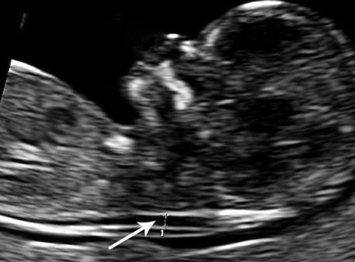 Figur 1  Ultralydbilde som viser sted for m&aring;ling av nakkeoppklaring hos foster. Foto T. M. Eggeb&oslash;