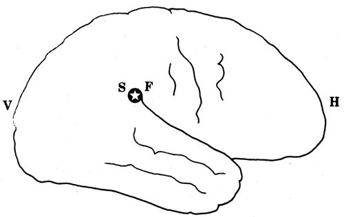 Fig 5  Fremmedlegeme p&aring; sprogsenteret. S: Sprogsenter. F: Fremmedlegeme. V: Venstre. H: H&oslash;yre