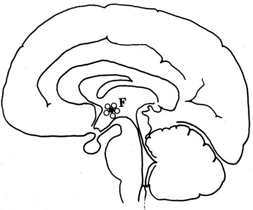Fig 6  Fremmedlegeme (F) p&aring; hypothalamus omgitt av fremmedlegemekjempeceller
