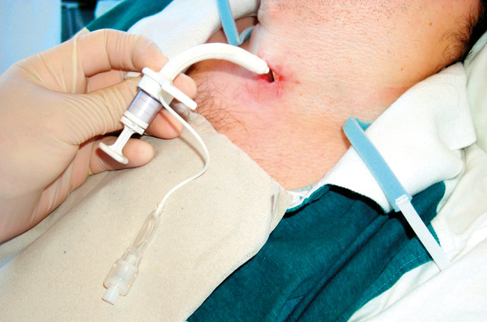 N&oslash;dtrakeotomi kan v&aelig;re et livbergende tiltak ved epiglotitt &ndash; her innleggelse av trakeostomitube via etablert trakeostoma&hellip;