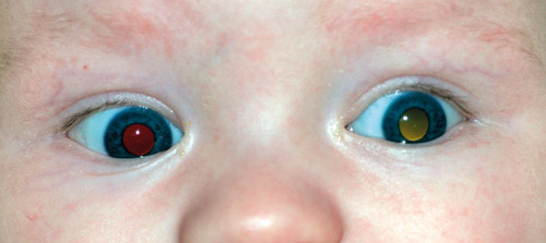 Figur 1  Leukokori p&aring; venstre &oslash;ye