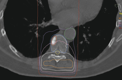 Figur 1  Eksempel p&aring; et konvensjonelt str&aring;lefelt. Bildet viser en metastase (r&oslash;d) i columna og omr&aring;det som behandles (bl&aring;tt)&hellip;