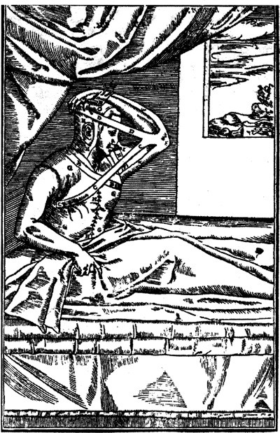 Figur 4  Hudlappen er sydd fast til nesen og armen immobilisert ved hjelp av et sinnrikt bandasjesystem. Tresnitt fra&hellip;