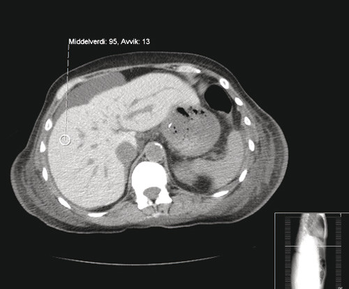 Figur 3  CT abdomen uten kontrastmiddel. Bildet viser h&oslash;y attenuasjon i lever, som ved jernavleiring (dette til&hellip;