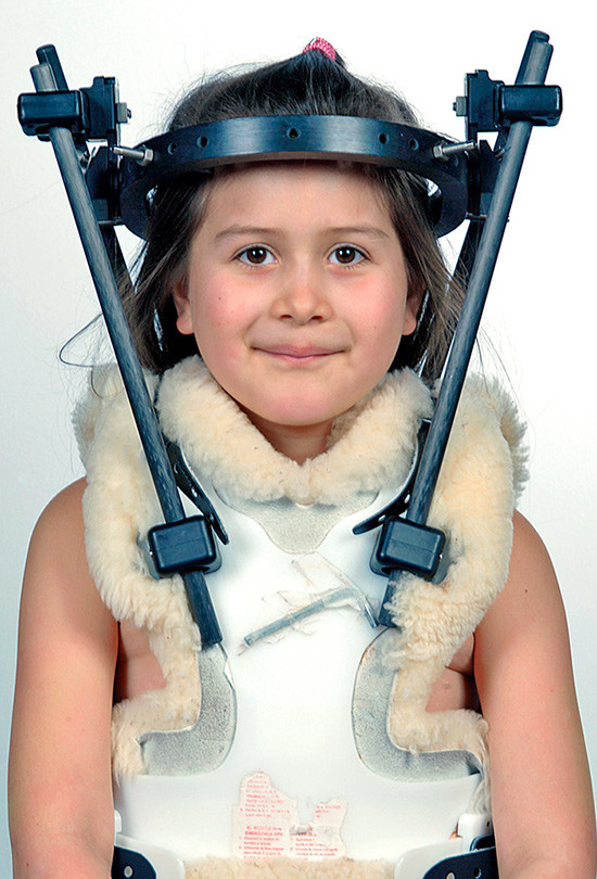 Figur 5  Postoperativ eksternfiksasjon i halovest. Pasienten og hennes foreldre har gitt samtykke til at bildet blir&hellip;