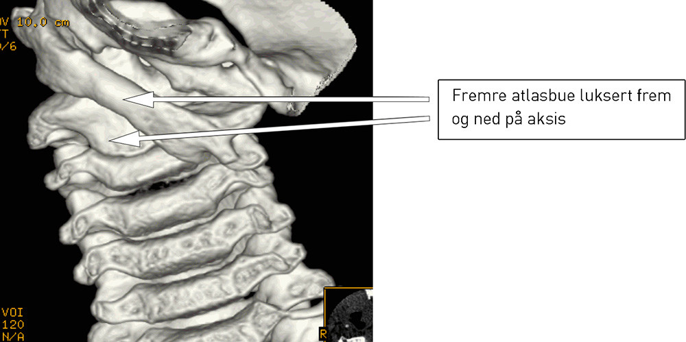 Figur 6  Totalluksasjon venstre C1/C2-ledd sett rett forfra