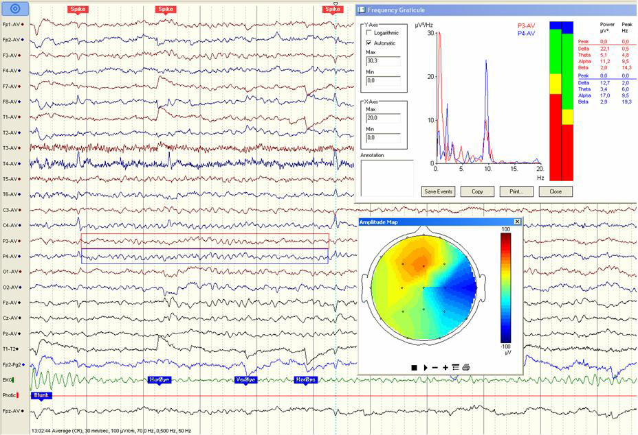 Figur 1  Epileptiform aktivitet hos v&aring;kent barn uten epilepsi, henvist med mistenkt AD/HD. Et s&oslash;vndeprivert EEG var normalt&hellip;
