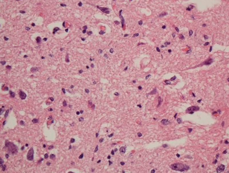 Figur 1  Forhorn, mulig nervecelletap (subtilt) og lett reaktiv gliose. Foto David Scheie