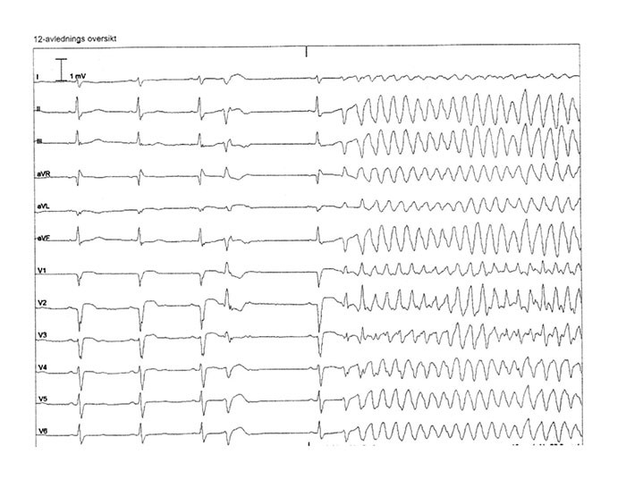 Figur 2  EKG viser to normalslag etterfulgt av en ventrikul&aelig;r ekstrasystole med kort koblingsinervall. Etter dette oppst&aring;r&hellip;