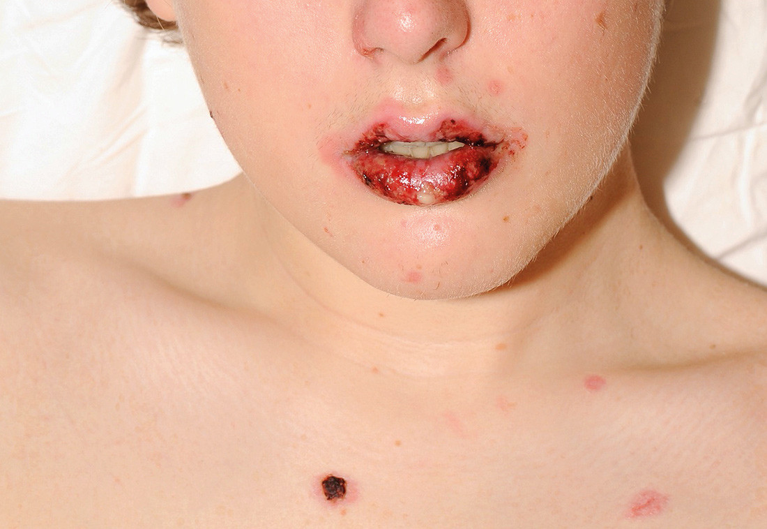 Figur 1  Ved innkomst hadde pasienten uttalt keilitt med erosjoner og kruster. Det er gitt tillatelse til bruk av bildene