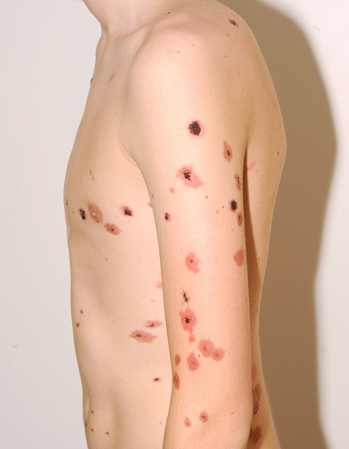 Figur 3  Under oppholdet gikk det bull&oslash;se utslettet p&aring; ekstremiteter og truncus gradvis tilbake