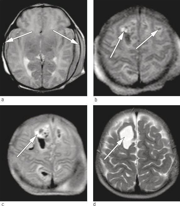 Figur 1  MR caput, T2-opptak med 1,5 tesla-maskin. Bildeopptak f&oslash;rste leved&oslash;gn viser a) ferske subdurale hematomer (piler)&hellip;