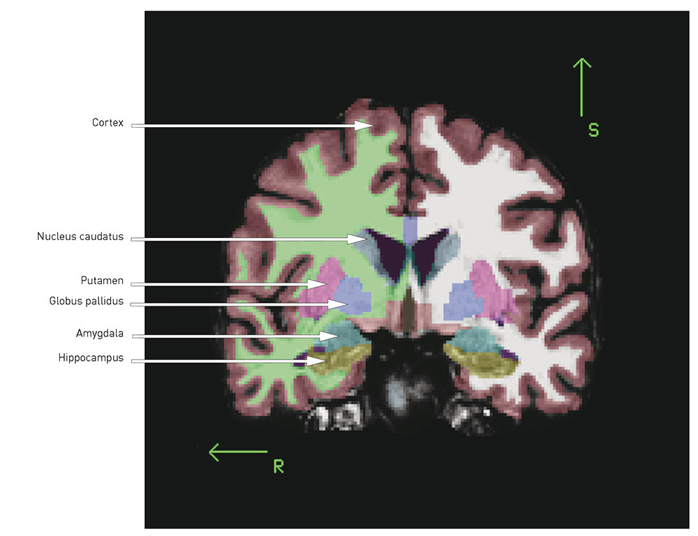 Figur 1  Koronalsnitt av T1-vektet MR-bilde, automatisk volumestimering med MR-postprosesseringsverkt&oslash;yet FreeSurfer. R =&hellip;