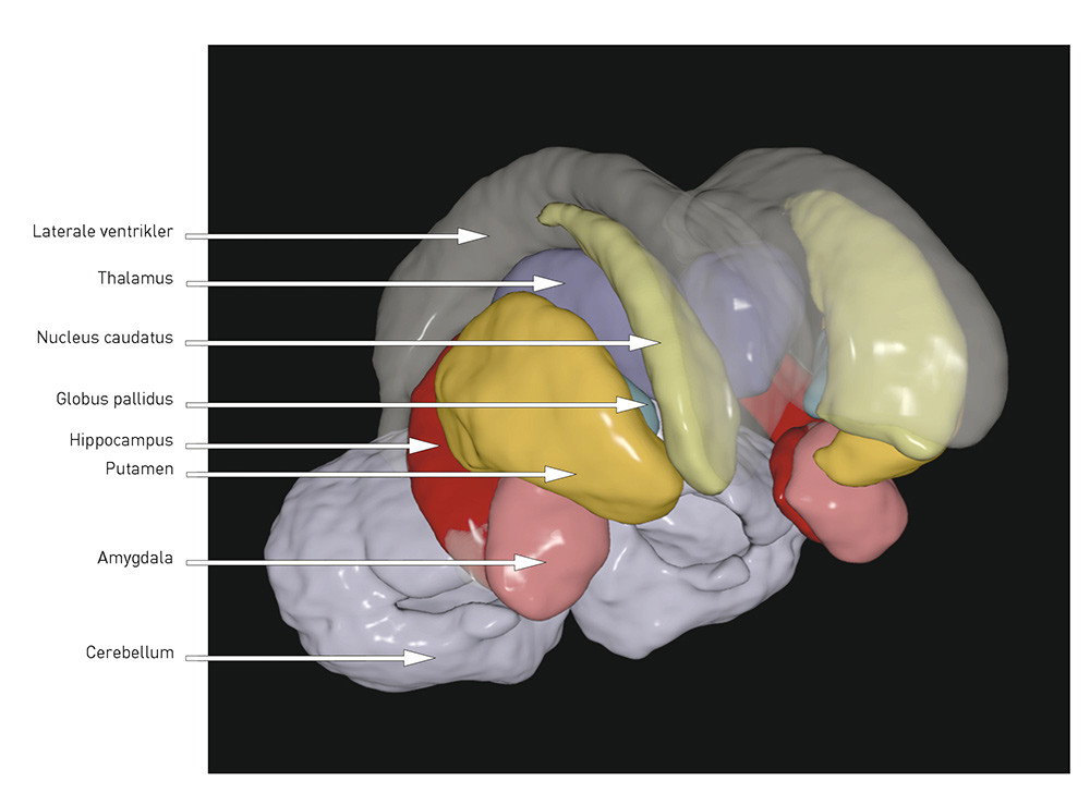 Figur 2  Tredimensjonal illustrasjon av subkortikale strukturer basert p&aring; et templat fra MR-postprosseseringsverkt&oslash;yet&hellip;
