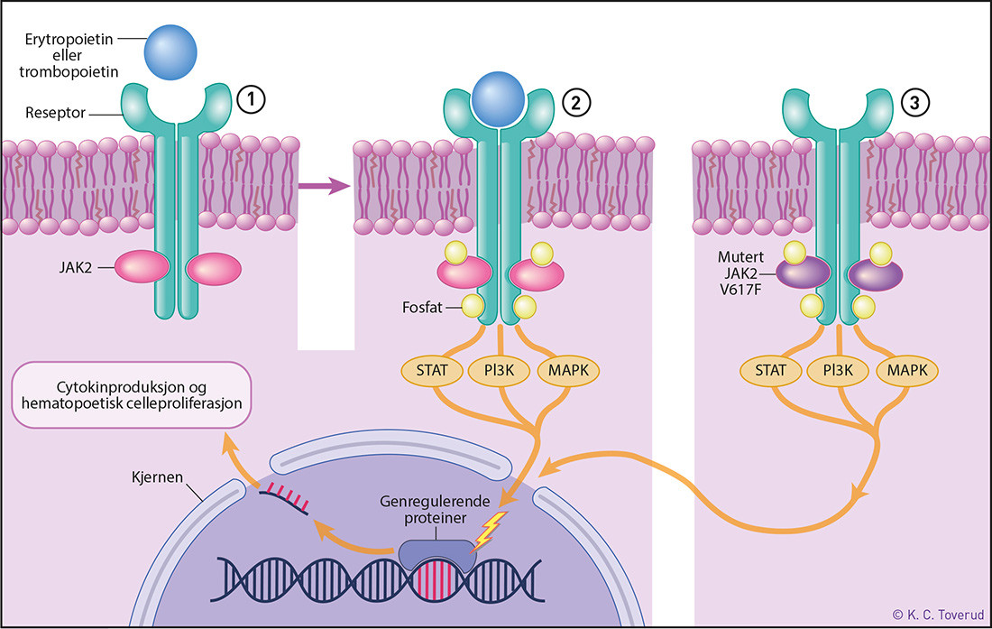 Figur 1  JAK2 er en intracytoplasmatisk ikke-reseptor tyrosinkinase. 1)Inaktiv villtype JAK2-reseptor p&aring; overflaten av de&hellip;