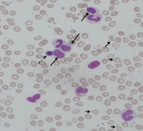 Figur 2  Typisk blodbilde ved prim&aelig;r myelofibrose med anisopoikilocytose og dr&aring;peformede erytrocytter (kort pil), og&hellip;