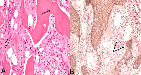 Figur 3  a) Prim&aelig;r myelofibrose med osteosklerose (lang pil) og megakryocyttansamling (kort pil) (hematoksylin-og&hellip;