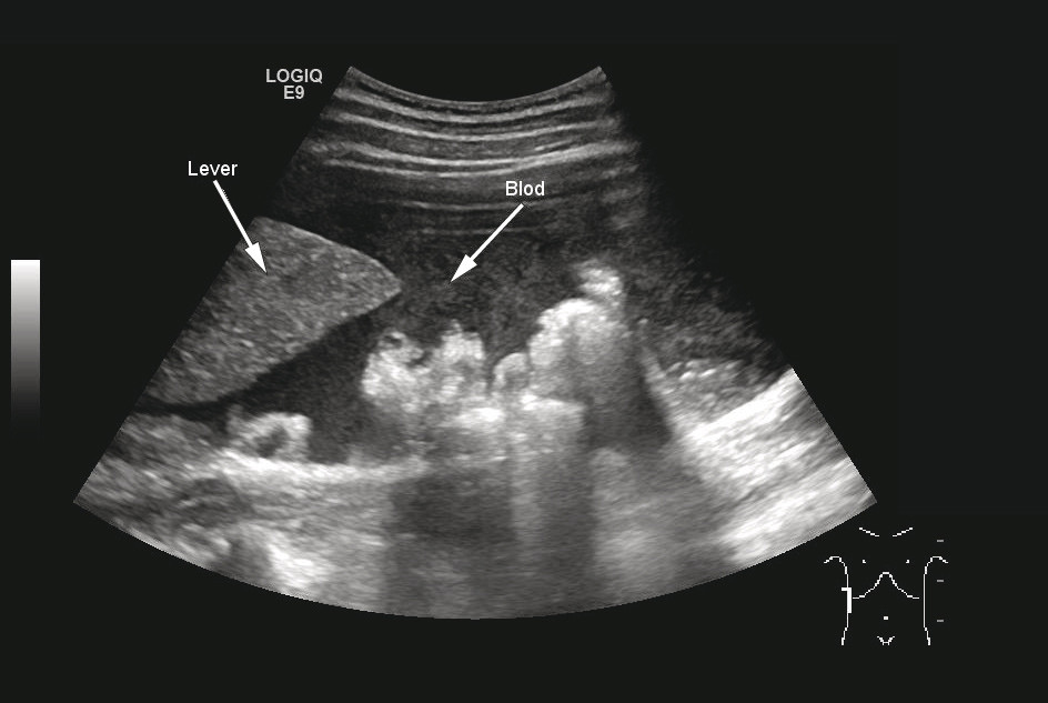 Figur 2  Ultralyd abdomen viste store mengder fri v&aelig;ske i buken med ekkom&oslash;nster forenlig med blod
