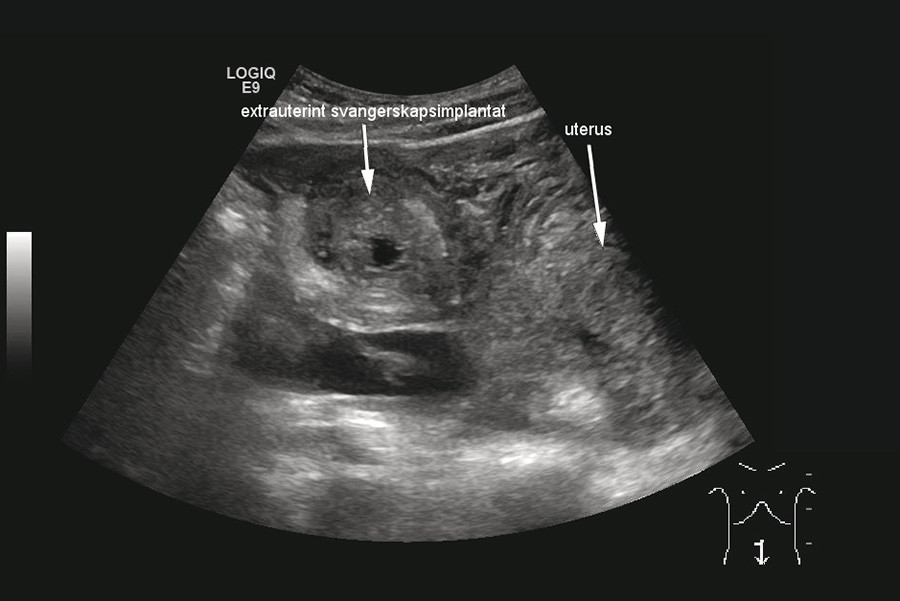 Figur 3  Ultralyd abdomen viste uregelmessig oppfylning p&aring; ca. 5 cm like kranialt for uterus, forenlig med ekstrauterin&hellip;