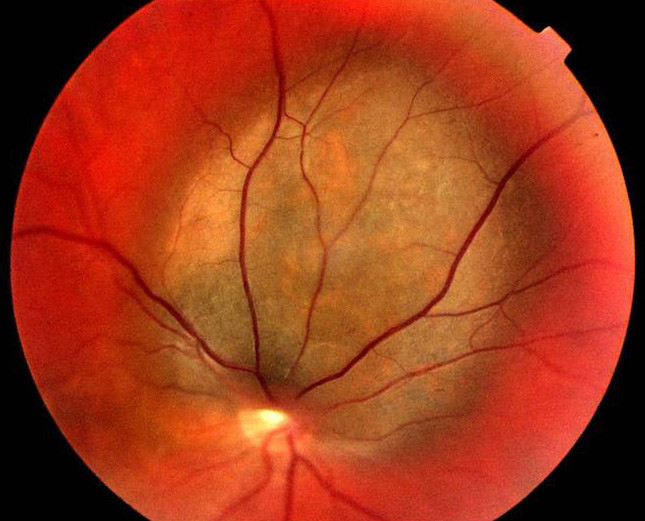 Figur 4  Malignt melanom med utgangspunkt i &oslash;yet. Foto Nils A. Eide