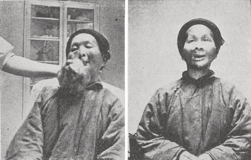 Barnehodestort, stilket fibrom; ca. 8 aars varighet. Blev av kinesiske l&aelig;ger anset for inoperabelt.�