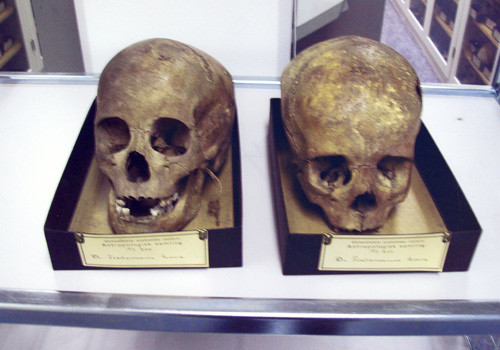 Figur 1  De aktuelle to barnas kranier og kalvarier fotografert i Anatomisk avdeling ved Universitetet i Oslo. Det bemerkes&hellip;