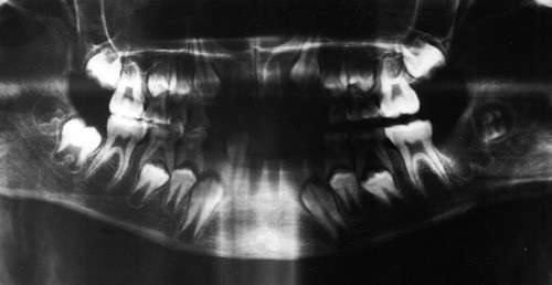 Figur 2  R&oslash;ntgenogram (ortopantogram) av det ene barnet viser blandingstannsett svarende til en alder p&aring; 8&thinsp;&ndash;&thinsp;9 &aring;r. Bemerk&hellip;