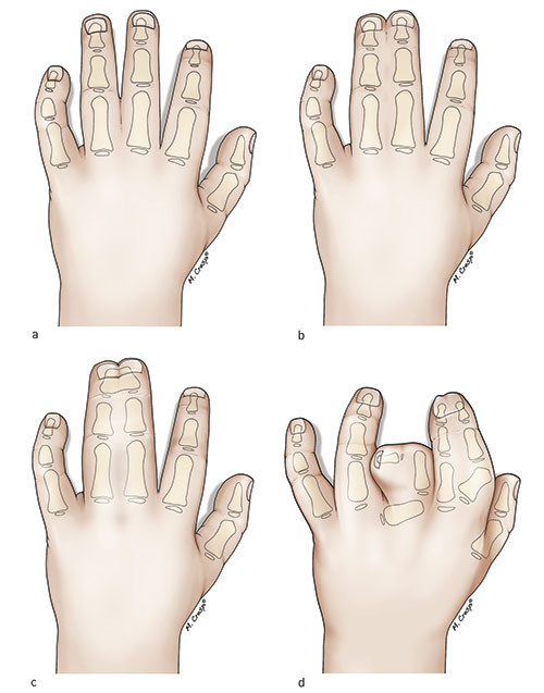 Figur 2  Inndeling av syndaktyli. Syndaktyli mellom lang- og ringfinger. a) Enkel, inkomplett syndaktyli b) Enkel, komplett&hellip;
