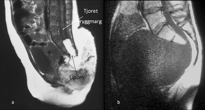 Figur 3  a) MR midtsagittalt snitt viser tjoret ryggmarg og intraspinalt lipom. b) MR midtsagittalt snitt med et mer enn 1&hellip;
