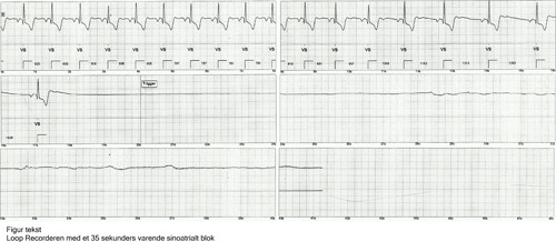 Figur 1  Afl&aelig;sning af loop recorderen viste et 35 sekunders varende sinoatrialt blok