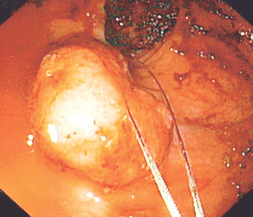 Figur 1 Den bredbasede rectumpolypp f&oslash;r reseksjon