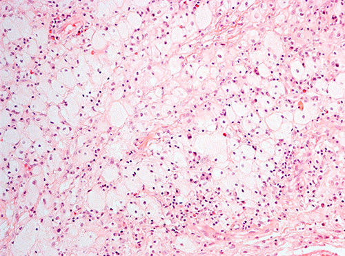 Figur 1  HE-farget snitt viser de typiske makrofagene med rikelig skummende cytoplasma (skummakrofager). Innimellom er det&hellip;