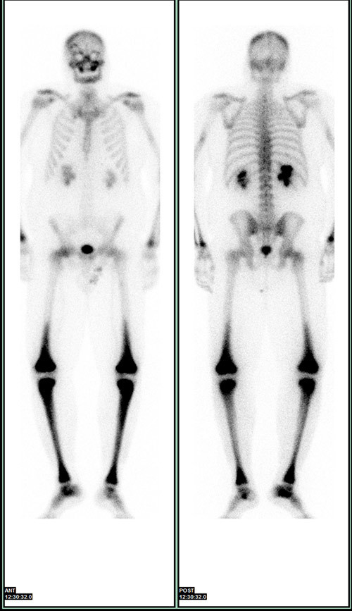 Figur 6  &Oslash;kt opptak i lange r&oslash;rknokler p&aring; skjelettscintigrafi