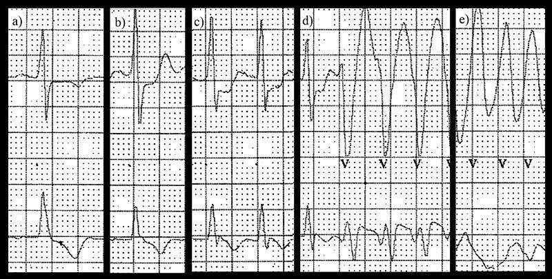 Figur 2  Detaljer fra 24-timers-EKG. 25 mm/s. a) Sinusrytme tidlig i opptaket. b) Sinusrytme like f&oslash;r omslag til c)&hellip;
