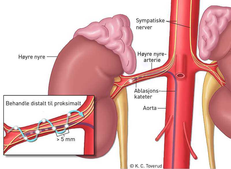 Figur 2  Ablasjonskateter i nyrearterie. Nervene er skjematisk illustrert. I hver nyrearterie utf&oslash;res 4&thinsp;&ndash;&thinsp;8 ablasjoner med 5&hellip;