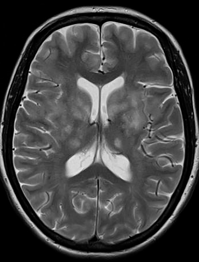 Figur 3  MR caput med aksial T2 viser progresjon av signalforandringer i basalganglier og thalamus bilateralt
