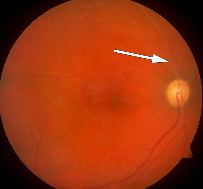 Figur 4  Fundusbilde av h&oslash;yre &oslash;ye. Okkluderte hvitlige kar b&aring;de p&aring; arterie- og veneside