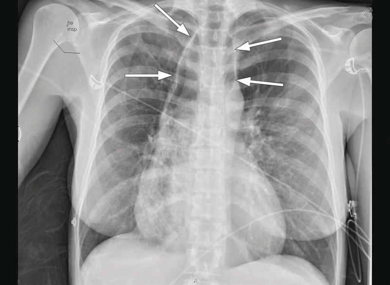 Figur 1  R&oslash;ntgen thorax, halvt sittende frontbilde innleggelsesdagen, viser luft projisert over &oslash;vre mediastinum. Merk at&hellip;