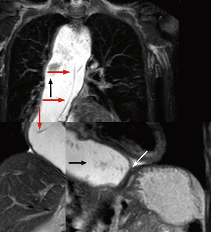 Figur 2  Fusjon av tre forskjellige MR-bilder viser slynget, dilatert oesophagus med matrester (svarte piler), innlagt sonde&hellip;