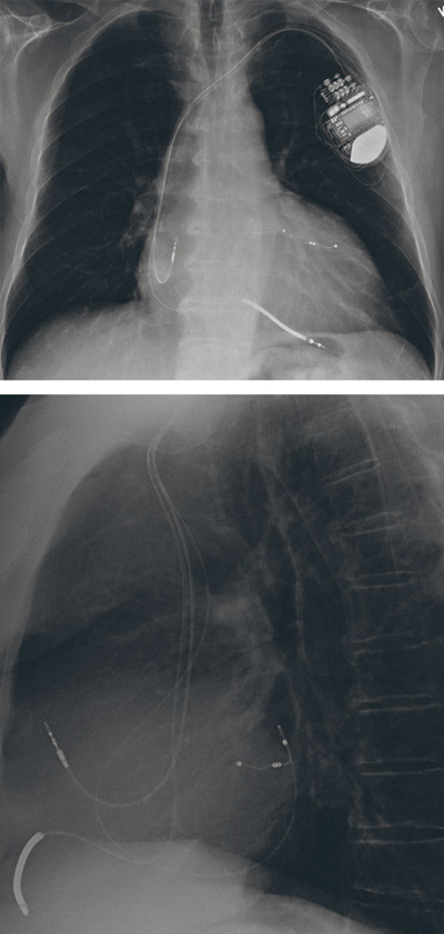 Figur 1  R&oslash;ntgen thorax (front- og sidebilde) av pasient med hjertesvikt og atriobiventrikul&aelig;rt hjertestartersystem (CRT-D)&hellip;