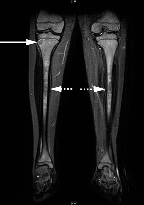 Figur 3  Inhomogen beinmargsstruktur bilateralt i tibia (stiplede piler) og lytisk lesjon i h&oslash;yre proksimale tibia &hellip;