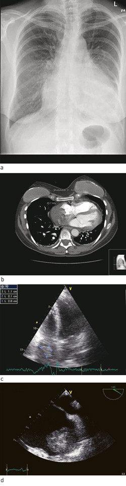 Figur 1  a) R&oslash;ntgen thorax viste stort hjerte med mistanke om perikardv&aelig;ske. b) Tumor i h&oslash;yre forkammer vist p&aring; CT, c)&hellip;