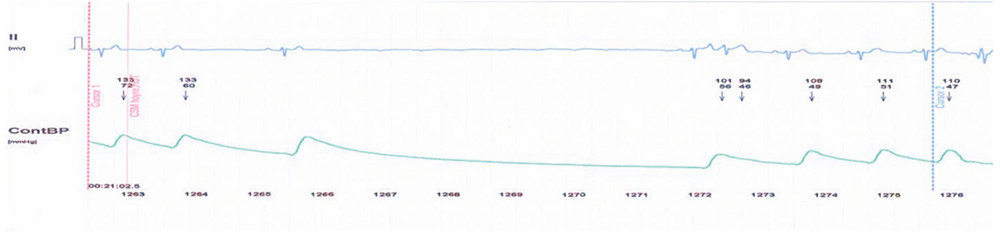 Figur 2  Utskrift av EKG- og blodtrykksregistrering fra v&aring;r pasient, som viser bradykardi og pause p&aring; seks sekunder i&hellip;