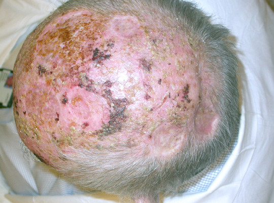 Figur 1  Multiple enkeltst&aring;ende og sammenhengende solare keratoser i hodebunnen hos en eldre mann. Det ses ogs&aring; kruster som&hellip;