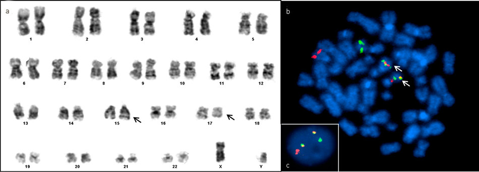Figur 2  Kromosomanalyse for p&aring;vising av t(15;17). Kromosomanalyse viser at endene p&aring; det eine kromosom 15 og kromosom 17&hellip;