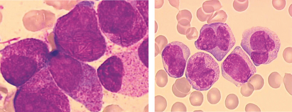 Figur 3  Morfologisk klassifisering av akutt promyelocyttleukemi. Biletet viser blodutstryk fr&aring; to pasientar med sjukdomen&hellip;