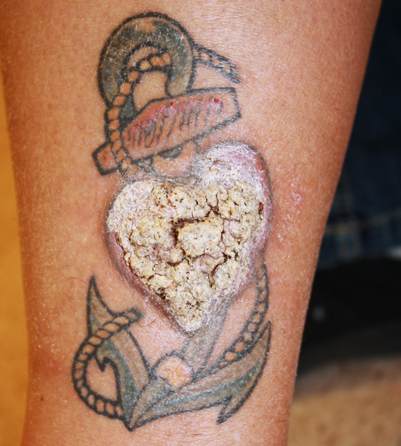 Figur 1  Hyperkeratotisk hudtumor i tatoveringen. Begge foto: Gudjon L. Gunnarsson