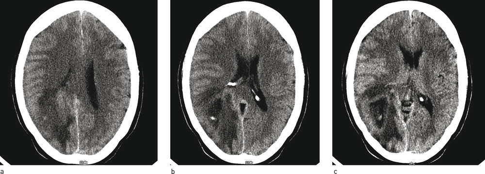 Figur 1  CT caput. H&oslash;yresidige parenkymforandringer parietooksipitalt med infiltrasjon av splenium corpus callosum, som kan&hellip;