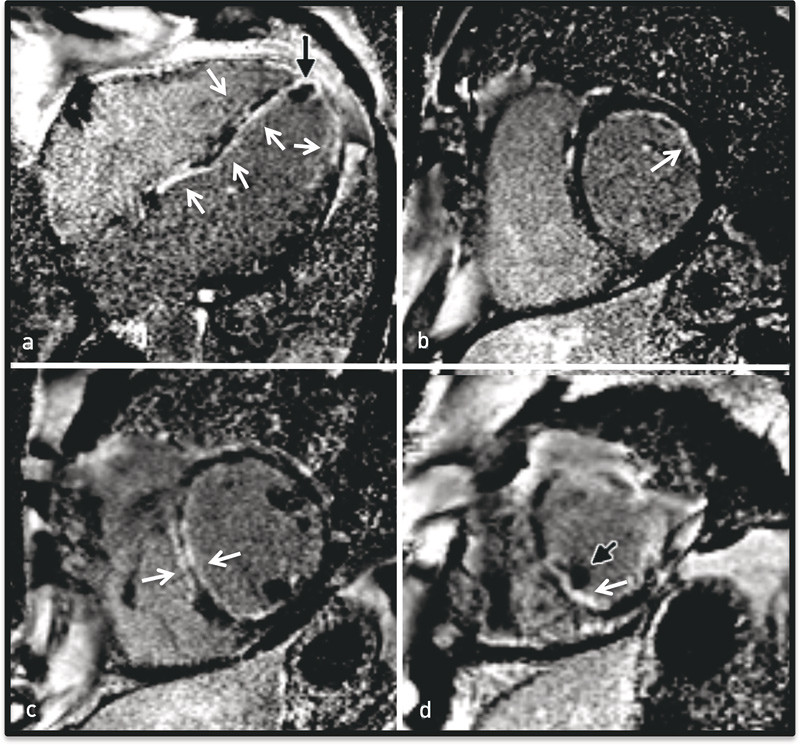Figur 4  MR-bilder tatt 10 minutter etter administrasjon av gadoliniumbasert kontrastmiddel, for fremstilling av omr&aring;der med&hellip;