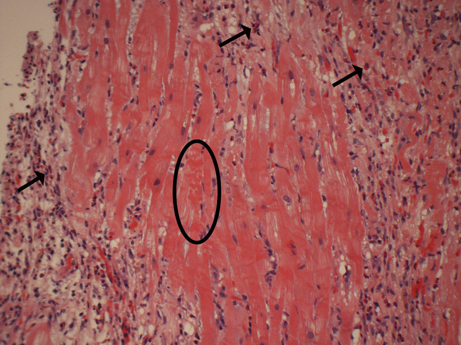 Figur 5  Biopsi fra myokard viste overveiende interstitielle forandringer, med fibrose og betennelse dominert av eosinofile&hellip;